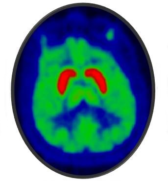 A positron emission tomography (PET) image of the human brain