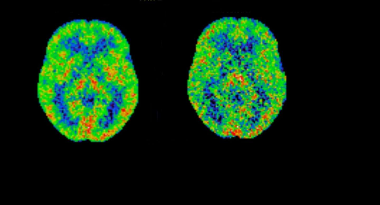 Positron emission tomography (PET) brain scans showing differences between a long duration and a short duration of untreated major depression